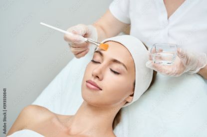 Picture of Chemical Peel