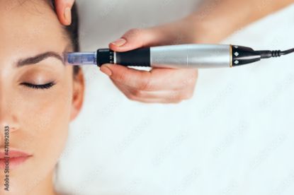 Picture of Microneedling