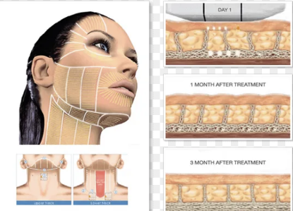 Picture of Ultherapy 